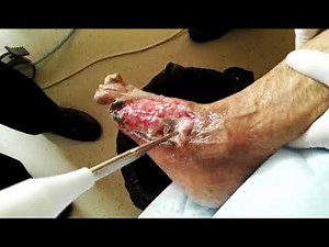 Lifotronic Care Master Wound Clean System