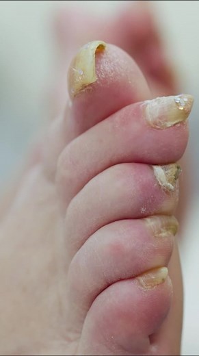The Bad Foot Clinic: Odor and Remedies