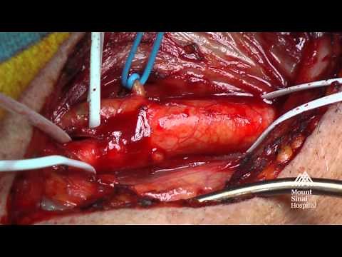 The Mount Sinai Surgical Film Atlas: Carotid Endarterectomy