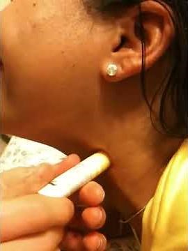 How to Properly Remove a Hickey