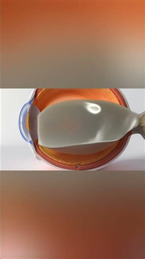 Retinal Detachment: How Vision Loss Begins