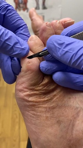 90_Little toe corn and callus (hard skin) removal by Australian podiatrist #callus #corn #hardskin #podiatrist #australi | Corn Removal