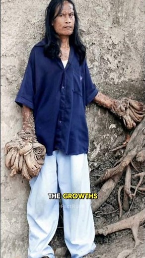 The Man Who Turned Into a Tree - Dede Koswara's Unbelievable Story