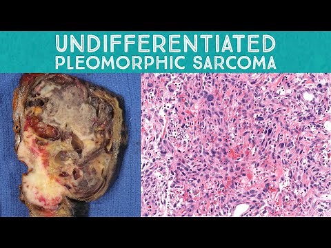 Spindle Cell Neoplasm Pathology 101: Undifferentiated pleomorphic sarcoma vs mimics (Oregon Case 1)
