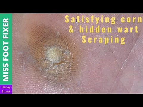 Satisfying Corn & hidden [Wart Scraping] | Miss Foot Fixer