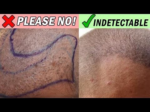 BUZZ Cut after Hair Transplant!? WATCH THIS FIRST...