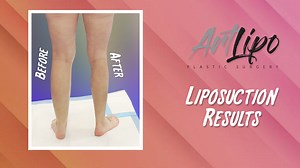 ULTRA-COMPLETE, HIGH-DEFINITION, AWAKE #LIPOSUCTION of the KNEE COMPLEX - this is lipo slimming of the entire knee extending half way up the lower thigh and extending over the top of the calves - performed by Liposuction Specialist #DrThomasSu. Slimmer and shapelier #Legs are Possible! ✨See Your Results Immediately!! ✨Minimal Downtime! @artlipoplasticsurgery! Call us today ☎️813-886-9090 or visit ➡️Artlipo.com to schedule a complimentary consultation! ✨FREE Virtual Consultations!! ✨Long distance