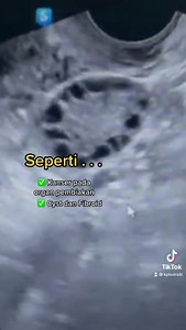 SCAN #PCOS MELALUI TRANSVAGINAL SCAN (TVS) . Transvaginal Scan ini...