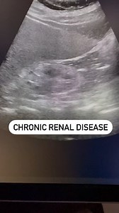 Chronic renal disease #ckd #renaldisease #renalfailure #renalultrasound #kidneydisease #kidneyfailure | Ultrasound made easy