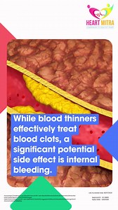 Blood thinners are commonly prescribed for individuals with heart or...