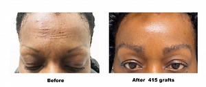 Eyebrow Transplant & Restoration | The Hair Restoration Center