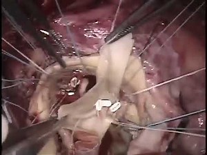 Missed Endocarditis [Commando Procedure]