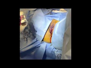 Before and after video of labiaplasty Procedure