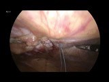 Port Site Hernia (with Strangulated Small Bowell) • Video • MEDtube.net