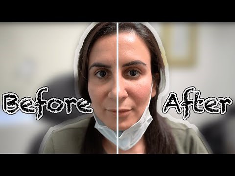 Under Eye Filler Before & After || Quick Saline Trial | Testing out Under eye filler Results
