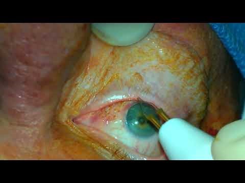 Conjunctival cautery for conjunctivochalasis