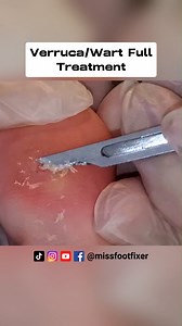13 reactions | Verruca/Wart Full Treatment *** Wart scraping*** Verruca on Toe By Miss Foot FIxer | Miss Foot Fixer | Facebook