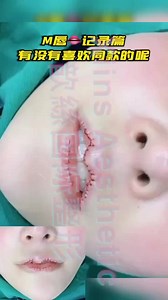 The sweet M lips have a super sweet smile immediately after operation, This Christmas special requires 5800 attractive babies. Don't miss #Lip plastic surgery #Lip repair #M lip #Petal lip #Mouth corner rising #Shorten in people #Deepen in people #Plastic repair hospital #Malaysia plastic surgery #Singapore plastic surgery #Vietnam plastic surgery #Myanmar plastic surgery #Indonesia plastic surgery #Brunei plastic surgery #Philippines plastic surgery #Kuala Lumpur plastic surgery #Xinshan plasti