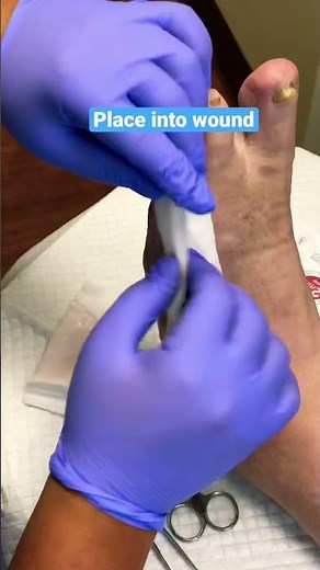 Applying a skin graft to a foot wound! #shorts