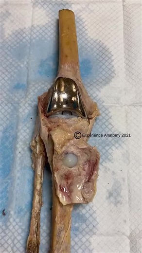 Understanding Knee Replacement Surgery: Key Facts