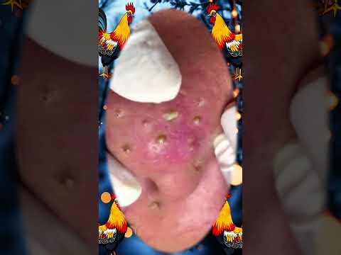 Giant Blackhead and Whitehead Removal from Nose | Satisfying Skincare Treatment