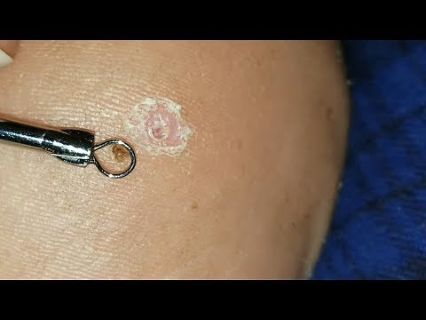 Infected Splinter Removed! Comes out CLEAN! Very Satisfying!