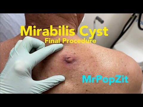 Final procedure! Giant Proteus Mirabilis abscess/infected cyst. Cyst reformed and I remove it.