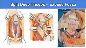 Elbow Trauma and Arthroplasty Approaches: Why Use a Triceps Approach for Elbow Trauma? How to Perform a Triceps Tongue Approach