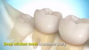 26K views · 446 reactions | Dent de Sagesse | Faculté de médecine | Facebook