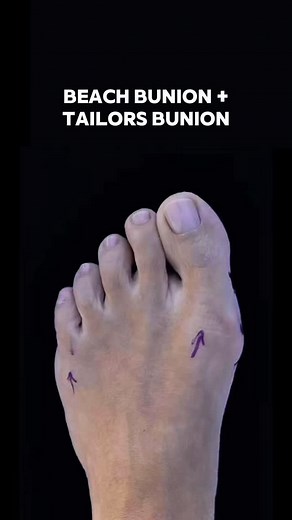 💉Treatment: Minimally Invasive Beach Bunion Tailors Bunion Akin Procedure 🎯Purpose: Alleviate pain and discomfort caused by the bunion and enhance the foot cosmetics 🤓 How it works: 1cm incision, cosmetic closure 🌟 Results: Immediate 😴 Anesthesia: Local ⏰ Time: 30-60 ❤️‍🩹Recovery: Inmediate weight bearing in post op shoe 📅 Lasts: Permanent 📍Location: 7975 NW 154th St Unit 244 Miami Lakes, FL 33016 United States 📲 Phone Number: (786) 610 - 3666 | Luxe Foot Surgery