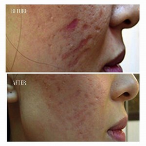 Do you suffer from acne scars or deep scars? At The Private Clinic, we offer a variety of treatments to target scars including Dermaroller, the effective treatment to target scars and achieve smoother and brighter looking skin. - To arrange a consultation with our skin specialists or dermatologists please contact us via 03300573766 | The Private Clinic of Harley Street