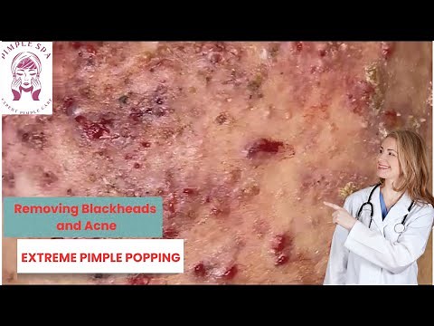 Giant Blackhead Removal - Satisfying Acne Extraction