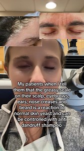 31K views · 49 reactions | Seborrheic dermatitis is an inflammatory condition most often caused by a reaction to common skin yeast called Malassezia. It causes greasy scale of the scalp and other oily parts of the face and even chest. Treatment is regular washing with an anti dandruff shampoo or other antifungal creams. Follow if you or someone you know suffers from Seborrheic dermatitis . #seborrheicdermatitis #dandruff #dermatologist | Dick Clark American Bandstand | Facebook