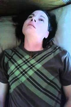 MY dystonia storm... simple treatment . video#1.movement disorders. Cervical dystonia. Involuntary