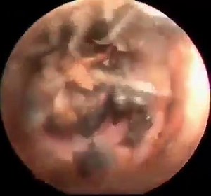 25K views · 49 reactions | Impacted Wax and a surprise in the ear.. | News Feed | Facebook