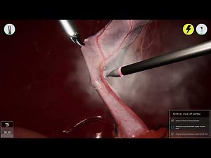 👩🏽‍⚕️LAPAROSCOPIC CHOLECYSTECTOMY / Gallbladder removal / 3D simulation