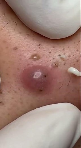 Deep Cystic Acne Extractions in Extreme Detail | Clean, Professional Technique