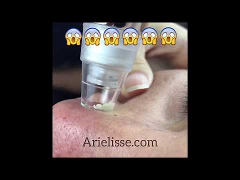 Blackhead Removal Tool Pore Suction Device Vacuum Machine Comedo