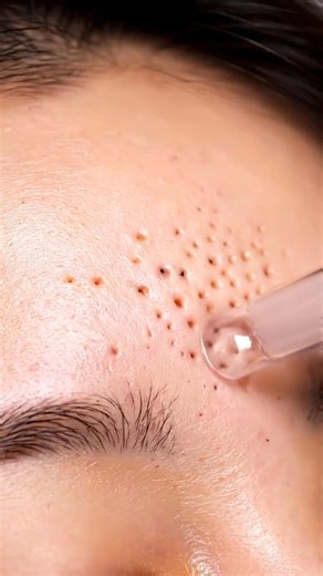 Satisfying Forehead Vacuum | Sebum & Pore Cleaning ASMR