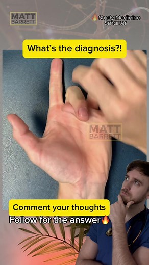 Understanding Trigger Finger: Symptoms and Insights