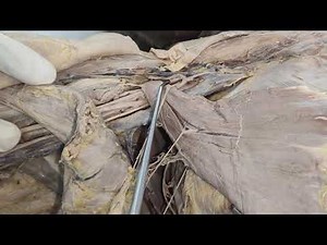 Dissection of Axilla