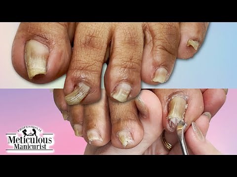 👣Curling Wavy PINCHING TOENAILS How to Clean & Restore👣