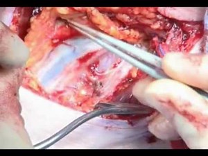Neck Dissection from 3D Anatomy for Otolaryngology and Head and Neck Surgery