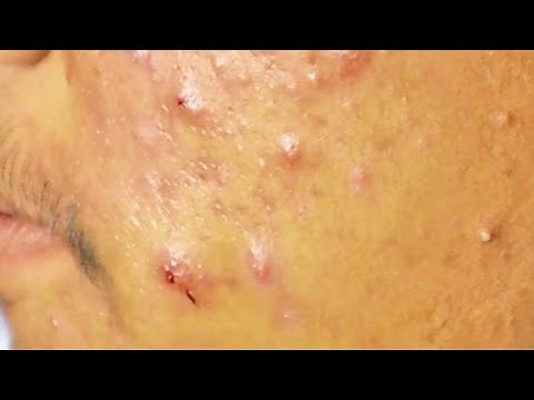 Extraction boutons et drainage le pus suintant d'un acné kystique sur le visage | cystic acne