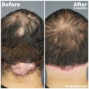 Acne Keloidalis Nuchae (AKN) comes in all shapes and sizes and is different for every person, but as Dr. Bumpinator, I am here to vanquish them all! 💪 Take a look at this astounding 5 month difference for this AKN patient -- although he's still healing, he's made amazing progress and I can't wait to see the final result. 🙌 Schedule your free consultation with Dr. Bumpinator at: https://bumpinator.com/bumpinator-akn-free-consultation-form/ #patienttransformation #transformation #transformationh