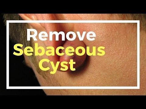 18 Remedies to Remove Sebaceous Cyst Naturally at Home