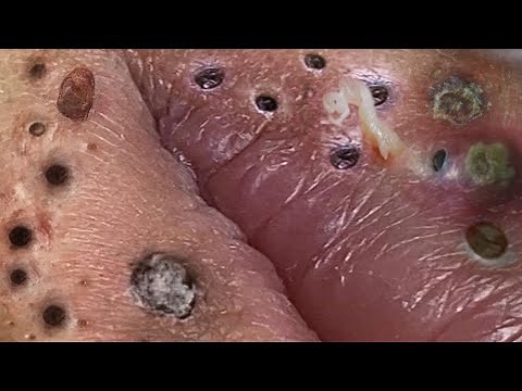 Relax Every Day With Loan Nguyen Spa | Acne Treatment Pimple Popping #39