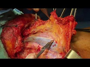 Modified Radical Neck Dissection (MRND) by Dr Rajshekhar C Jaka