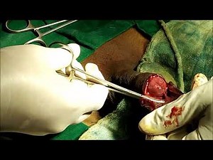 Circumcision Operation, Sunnat Surgery at Elegance Clinic, Surat, Gujarat, India.