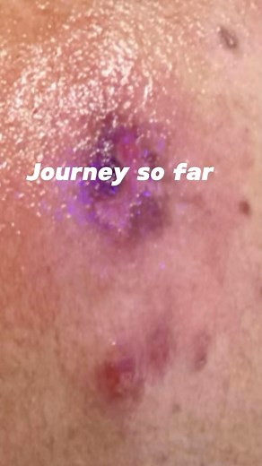 Impetigo is a Skin conditions that produce sores, blisters, and...